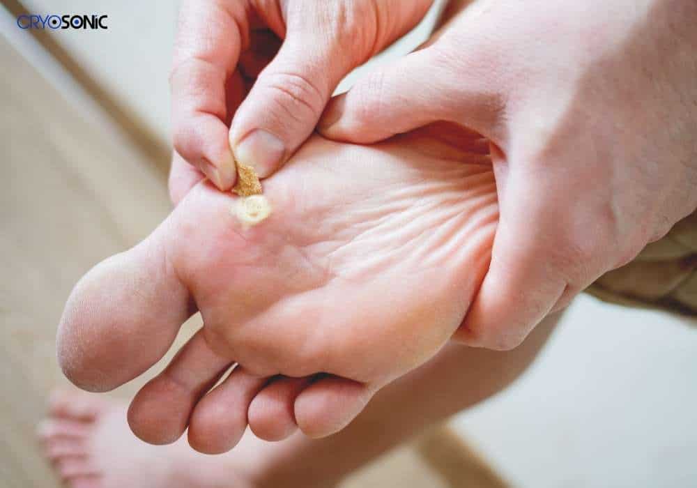 Preventing Future Mosaic Warts: Best Practices Leicester