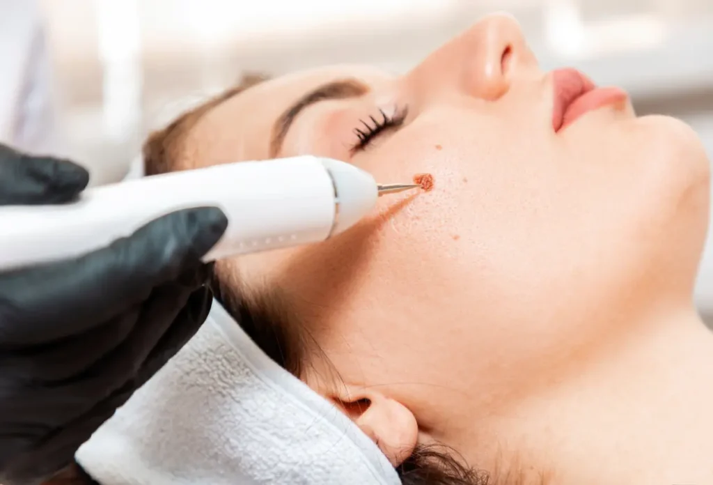 FAQs for CryoPen Aftercare Tips Leicester